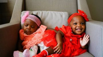 Yapışık İkizler Yeniden Doğdu !