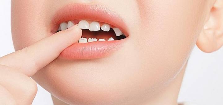 Çürük Dişler Fazla Kilo Almanıza Yol Açabilir