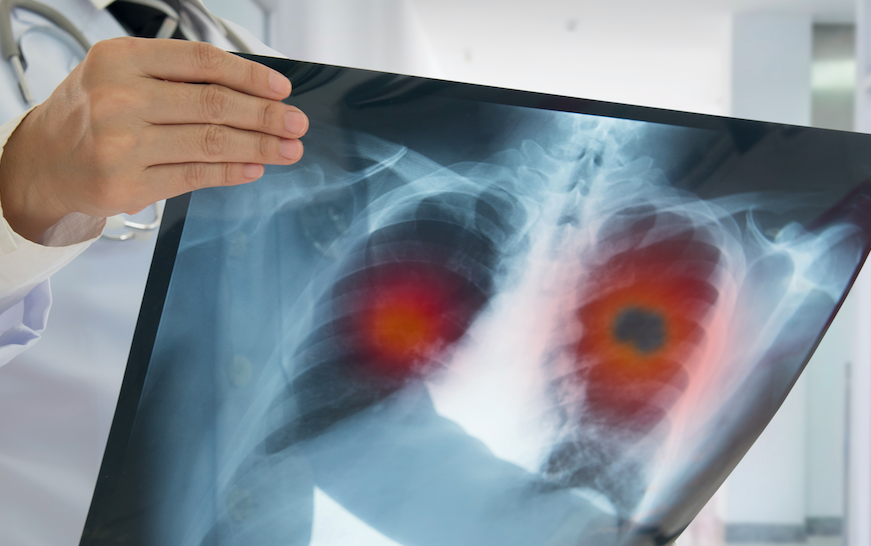 Dikkat Akciğer Embolisi Olma Riskiniz Olabilir