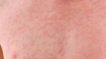 İstanbul’da Kızamık Alarmı !