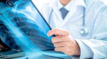 Türkiye’de 2023’te 41 bin Kişiye Akciğer Kanseri Tanısı Kondu