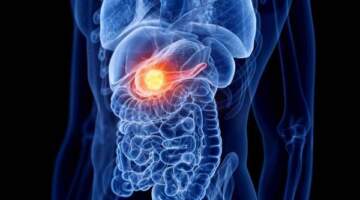 Pankreas Kanseri Tedavisinde Yenilikçi Yaklaşım