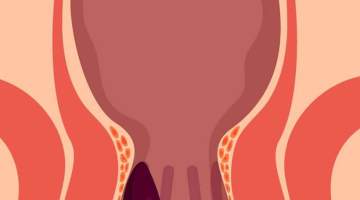 Uzun Süren Kabızlık Hemoroid Yapar mı ?