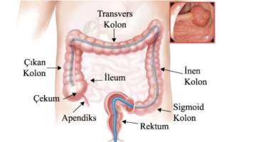 Kalın Bağırsak Kanserinde Poliplerin Önemi