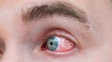 Göz Alerjisi Deyip Geçmeyin